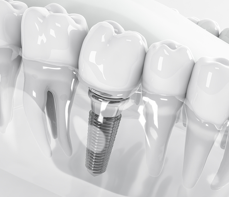 Sleep Implant